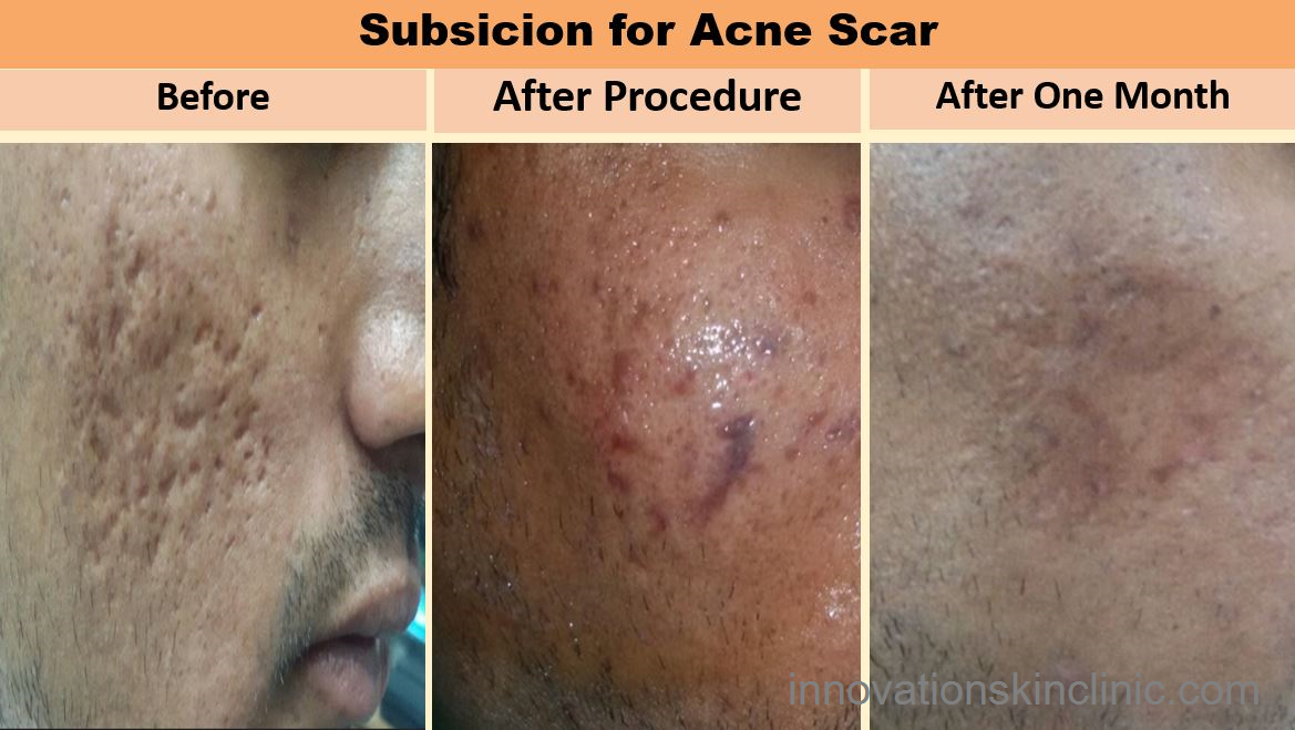 Acne Scars 1